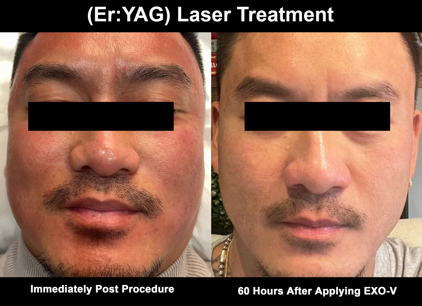 Er:YAG laser treatment — immediately post procedure compared to sixty hours after applying EXO-V