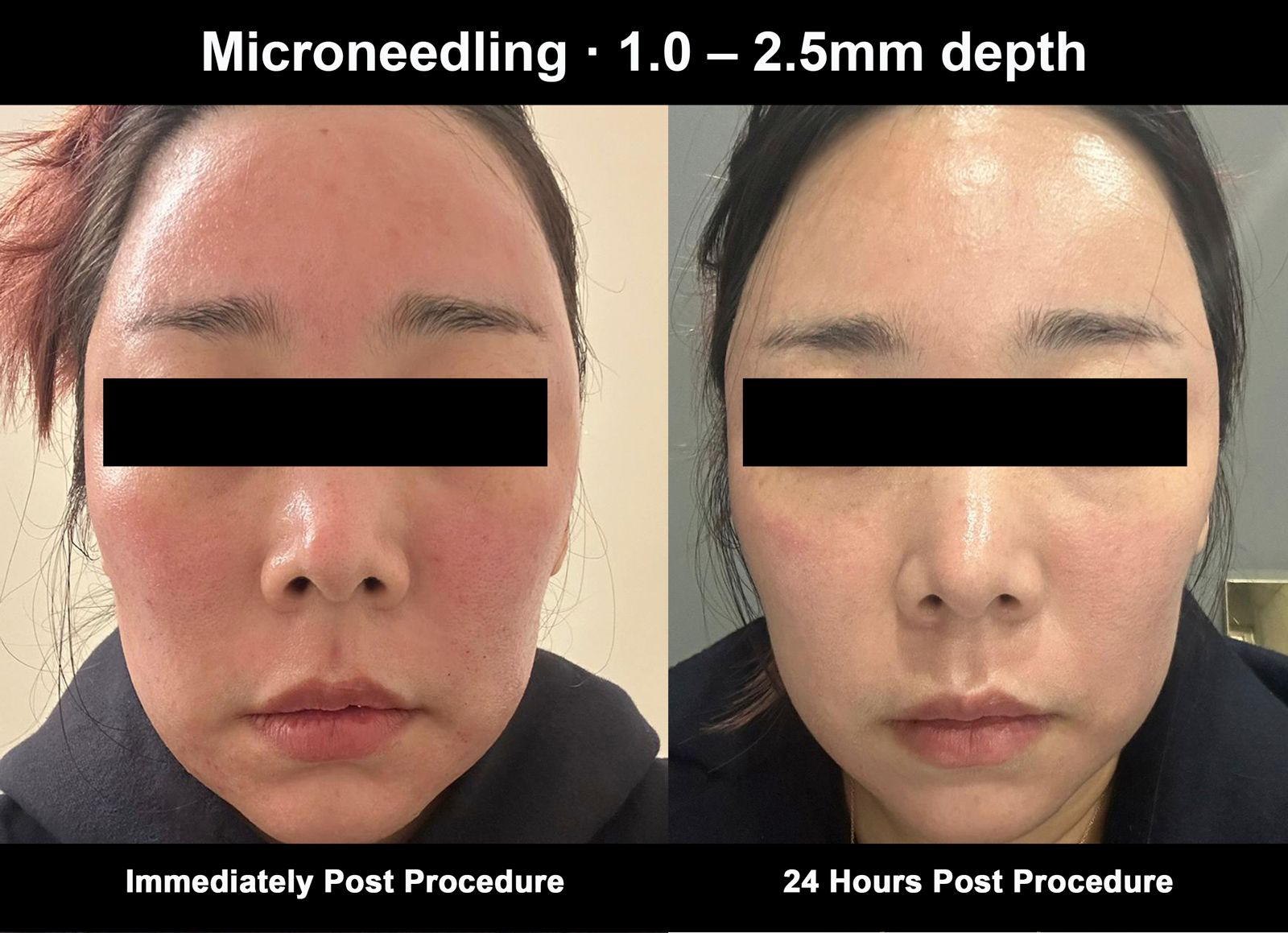 Microneedling 1.0 to 2.5mm depth — immediately post procedure compared to twenty-four hours post procedure