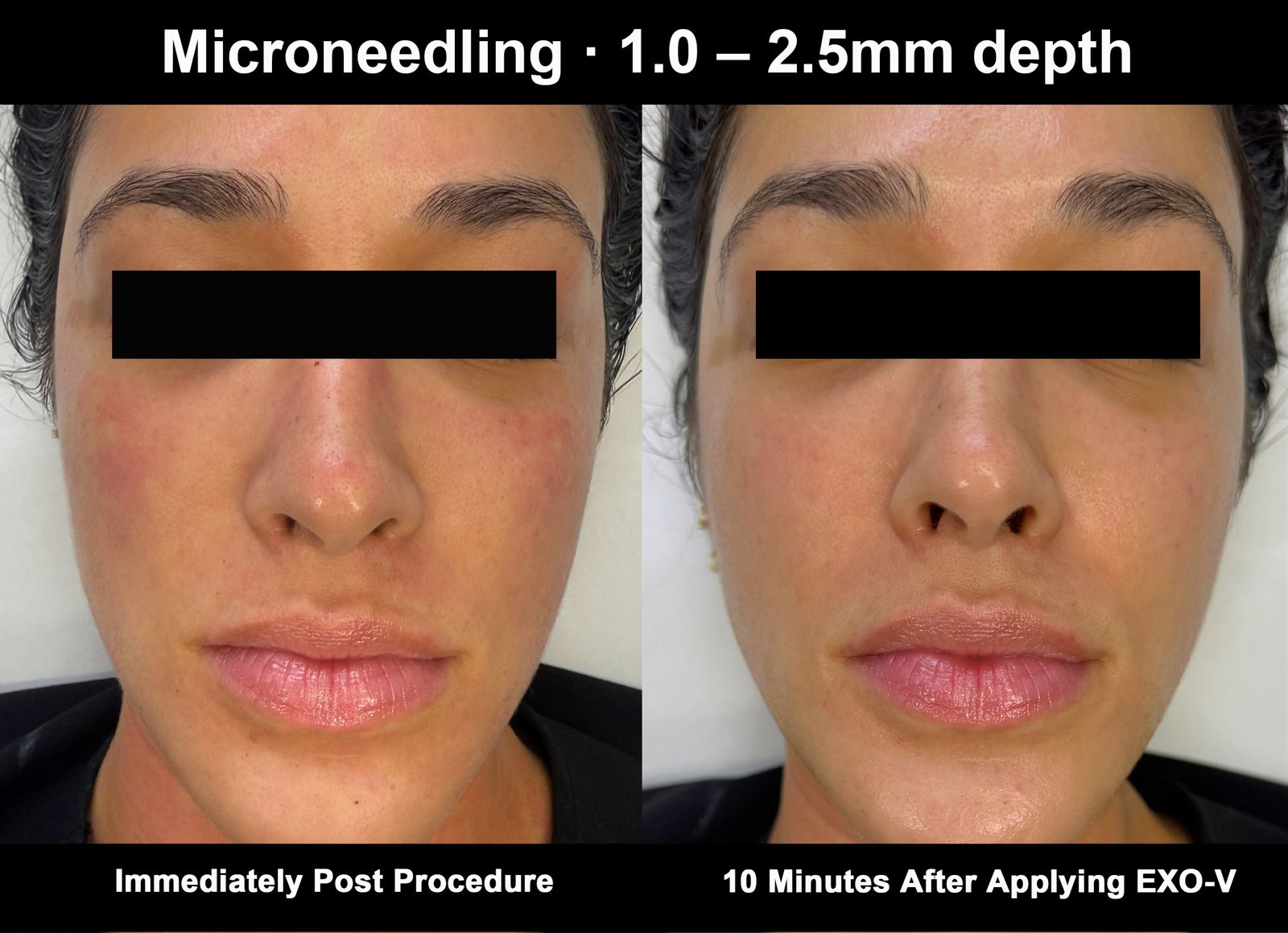 Microneedling 1.0 to 2.5mm depth — immediately post procedure compared to ten minutes after applying EXO-V