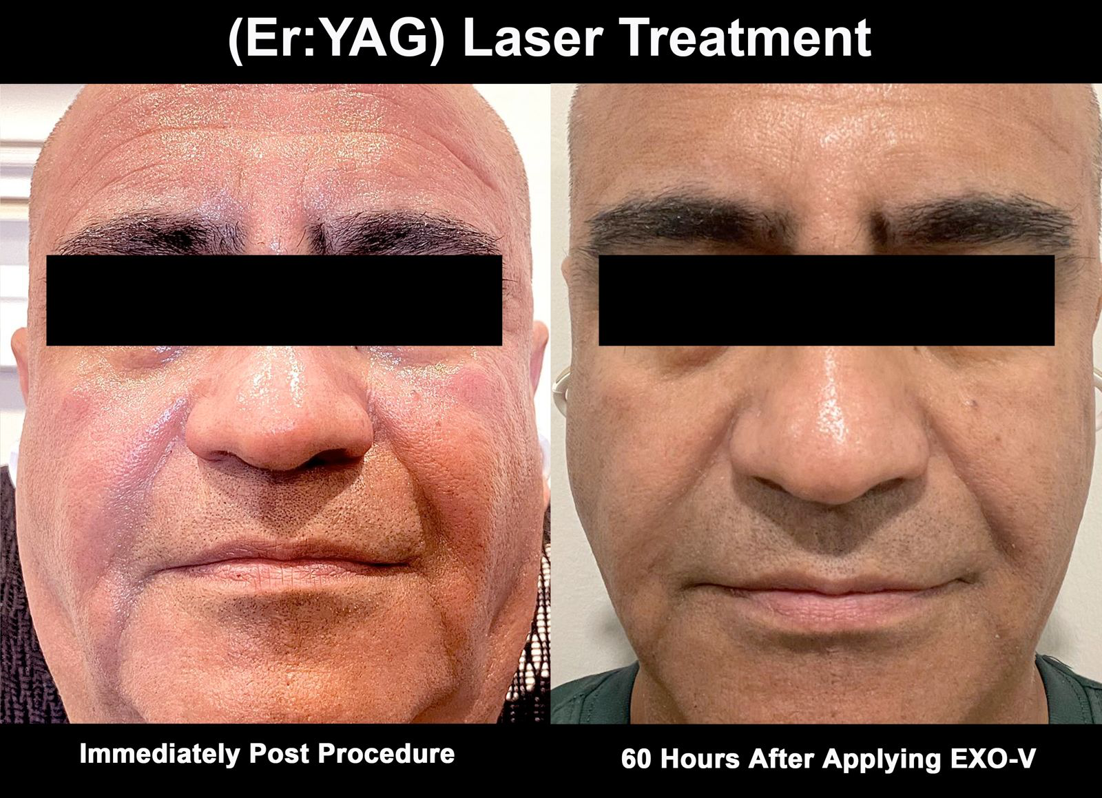 Er:YAG laser treatment — immediately post procedure compared to sixty hours after applying EXO-V
