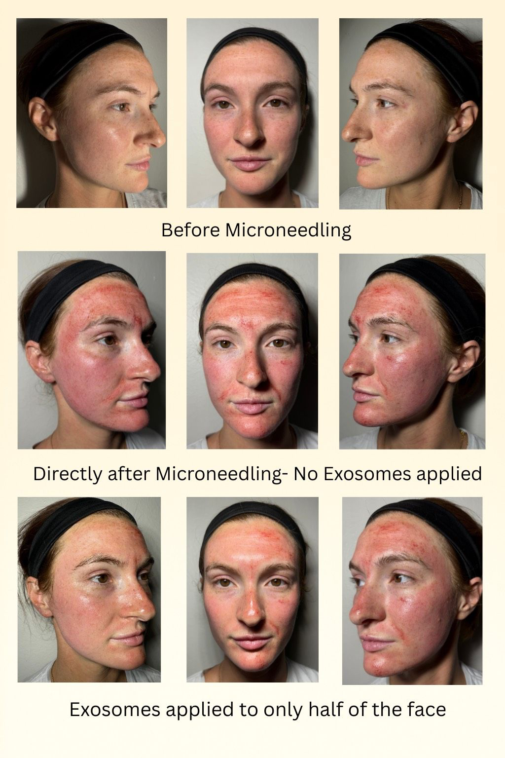 Microneedling before and after, with exosomes applied to only half of the face for comparison